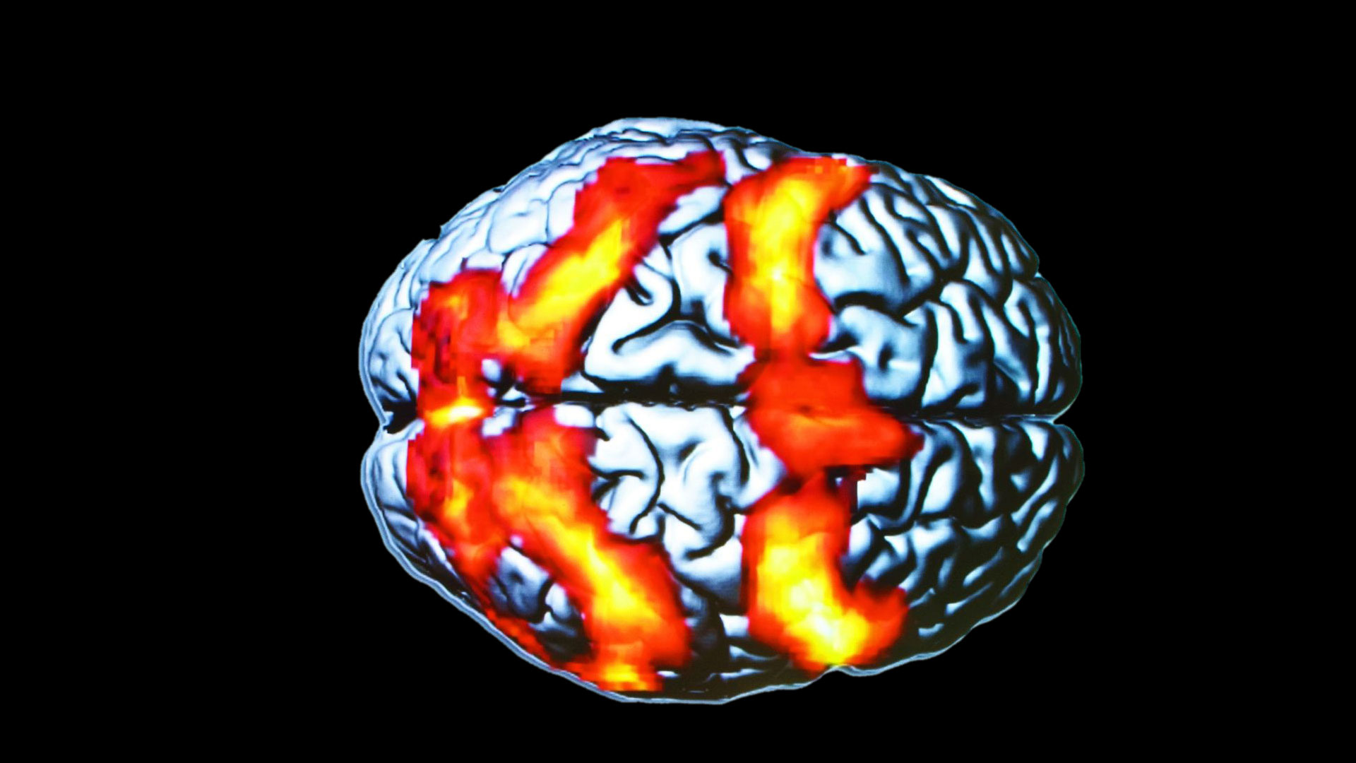 L'IRM permet de voir les régions qui s'activent dans le cerveau. Ce cliché d’IRM fonctionnelle n’a rien à voir avec un test de Rorschach (ces planches utilisées en psychiatrie pour évaluer la santé psychiatrique d’un individu). Les taches orange correspondent aux régions du cerveau activées par un sujet lors d’un exercice durant lequel il devait suivre des yeux une cible mobile.
© CNRS Photothèque, Ci-Naps, Laurent Petit, Bernard Mazoyer