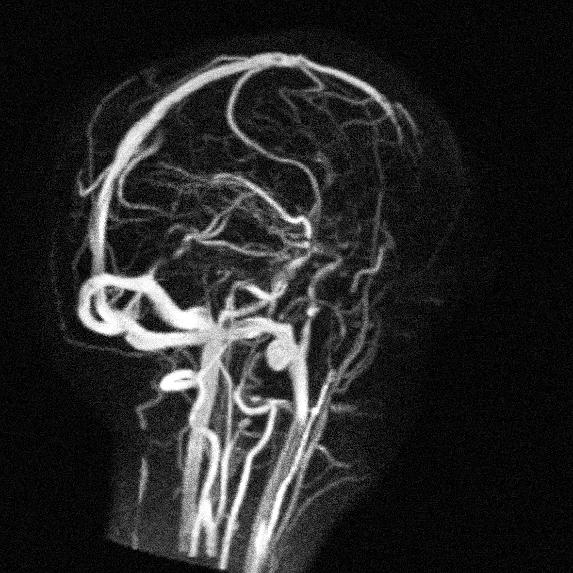 La résonance magnétique révèle les vaisseaux du cerveau