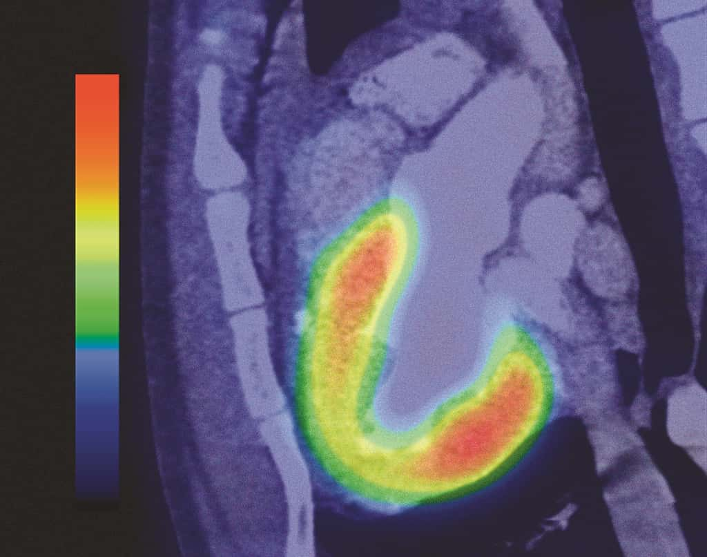 Le FDG, marqueur du cœur, du cerveau… et des tumeurs