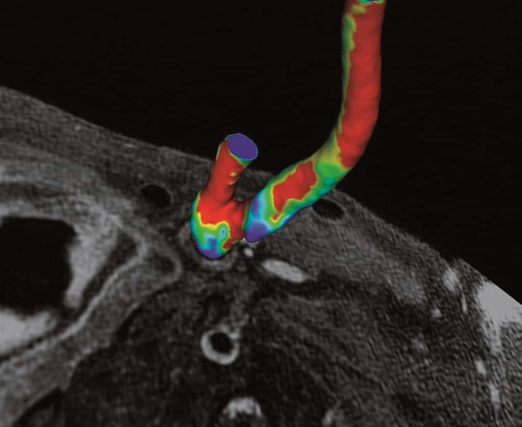 L'IRM pour mesurer le flux sanguin