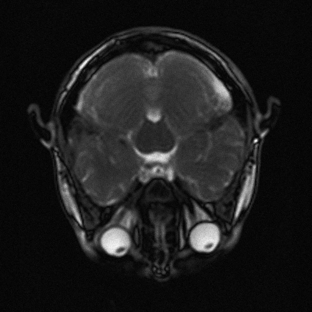 IRM montrant des yeux globuleux